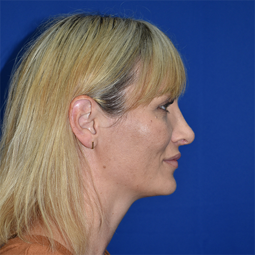 Rhinoplasty