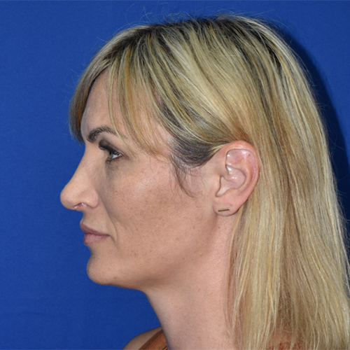 Rhinoplasty