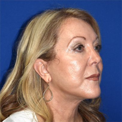 Facelift