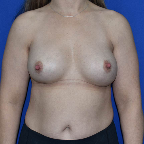 Breast Augmentation