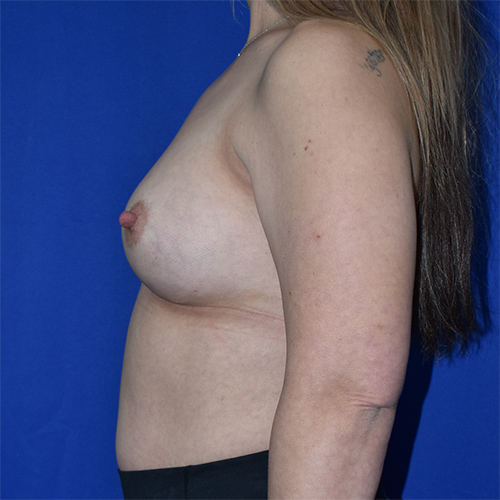 Breast Implant Revision