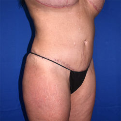 Liposuction