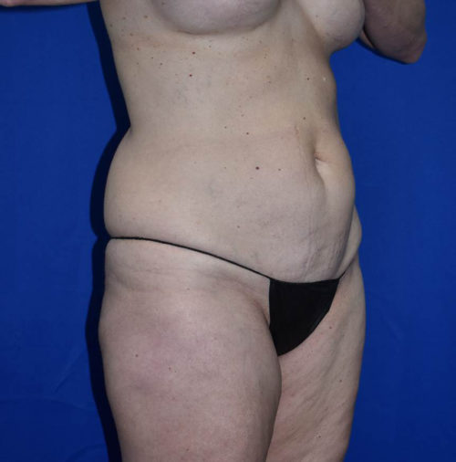 Abdominoplasty