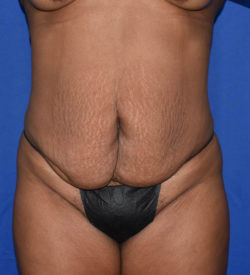 Abdominoplasty