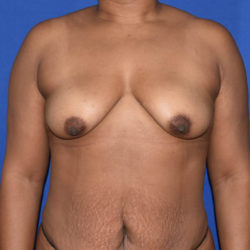 Breast Augmentation With Lift