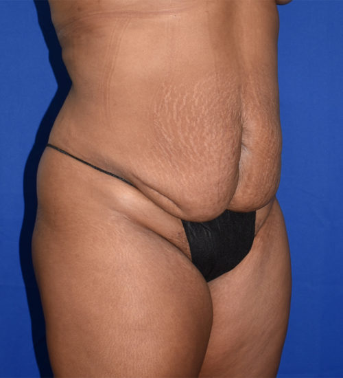 Abdominoplasty