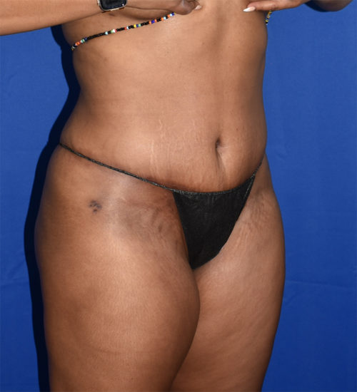 Abdominoplasty