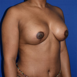 Breast Augmentation With Lift