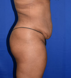 Abdominoplasty