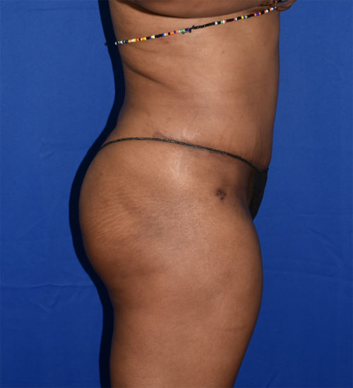 Abdominoplasty