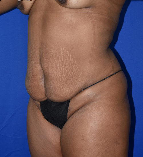 Abdominoplasty