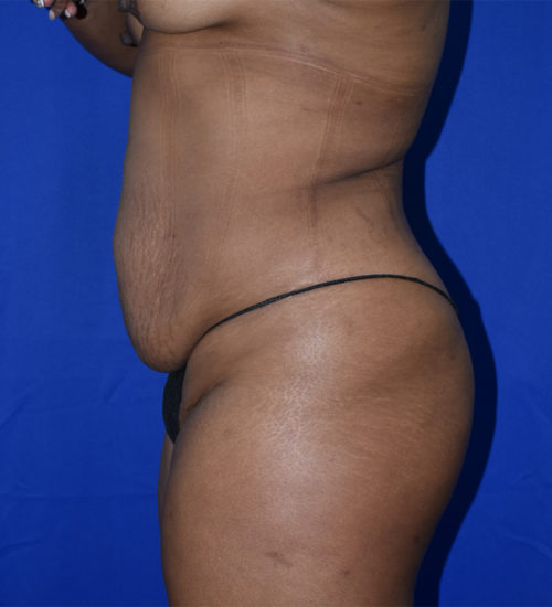 Abdominoplasty