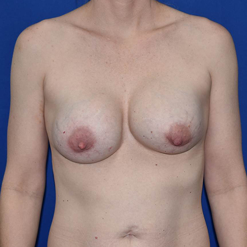 Breast Implant Revision