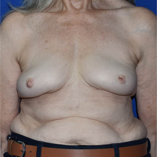 Breast Implant Removal