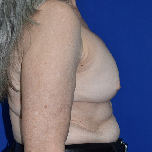 Breast Implant Removal