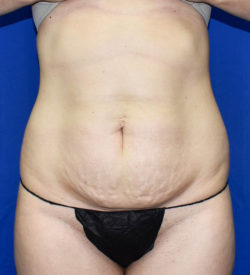 Abdominoplasty