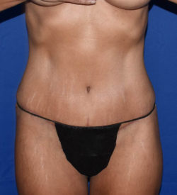 Abdominoplasty