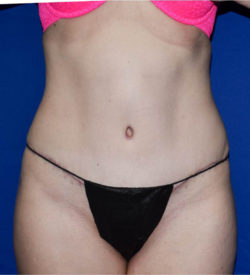 Abdominoplasty