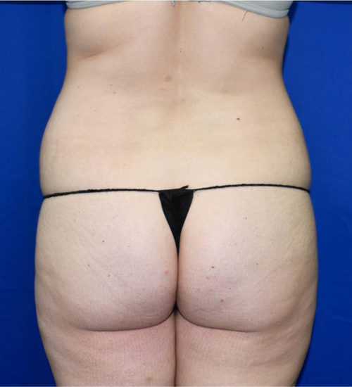 Abdominoplasty