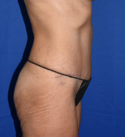 Abdominoplasty