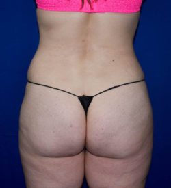 Abdominoplasty