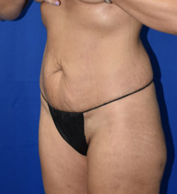 Abdominoplasty