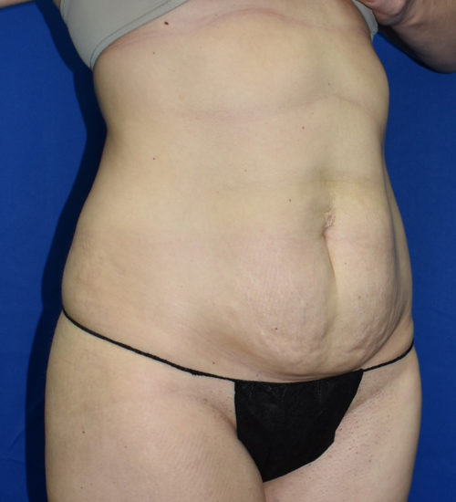 Abdominoplasty