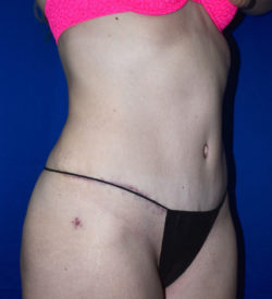 Abdominoplasty