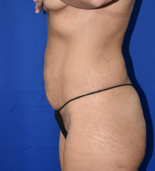 Abdominoplasty