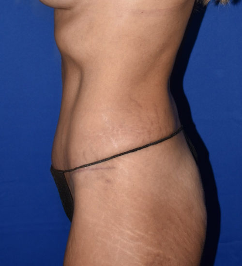 Abdominoplasty