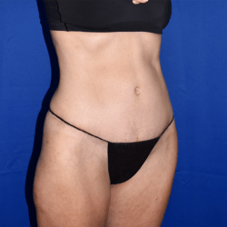 Abdominoplasty