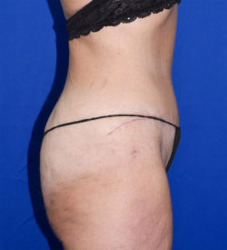 Abdominoplasty