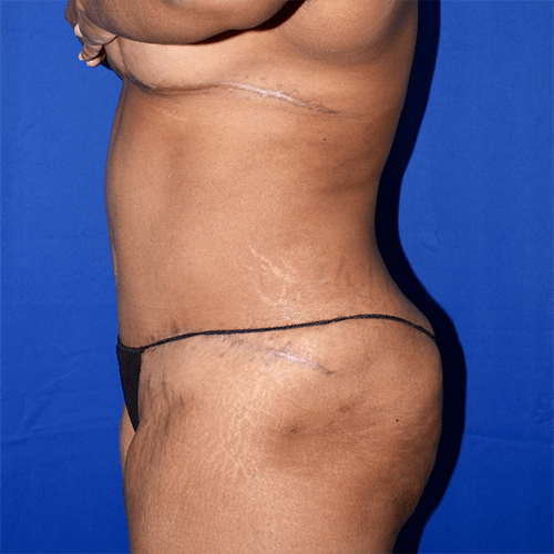 Abdominoplasty