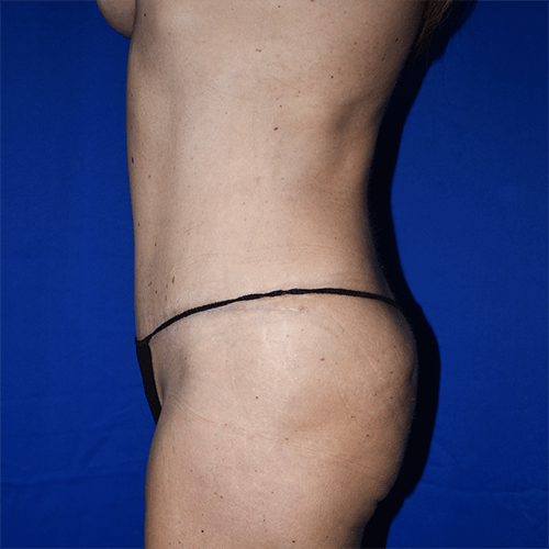 Abdominoplasty