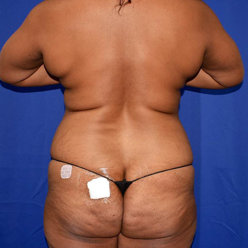 Abdominoplasty