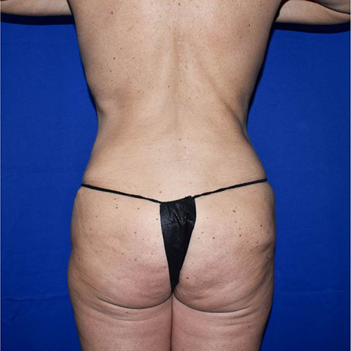 Abdominoplasty