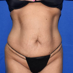 Abdominoplasty