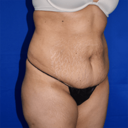 Abdominoplasty