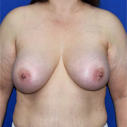 Breast Augmentation