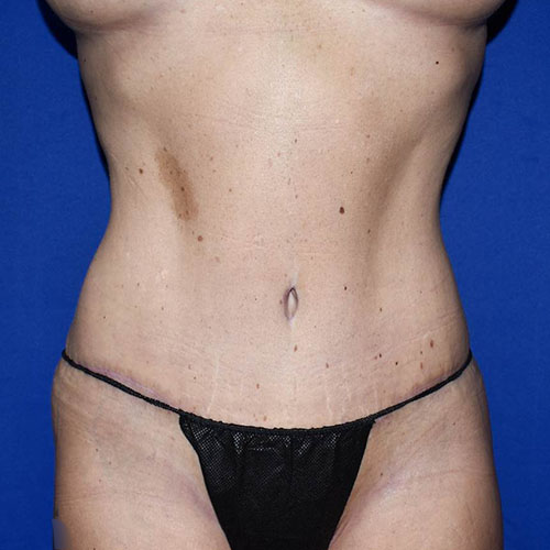 Abdominoplasty