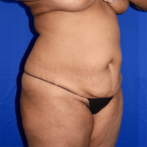 Abdominoplasty