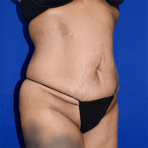 Abdominoplasty