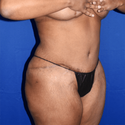 Abdominoplasty