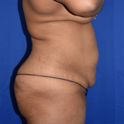 Abdominoplasty