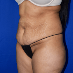 Abdominoplasty