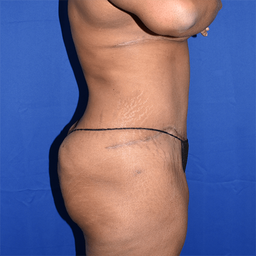 Abdominoplasty