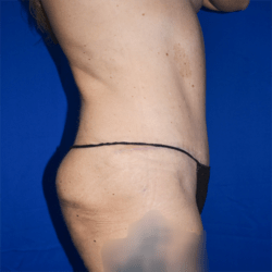 Abdominoplasty