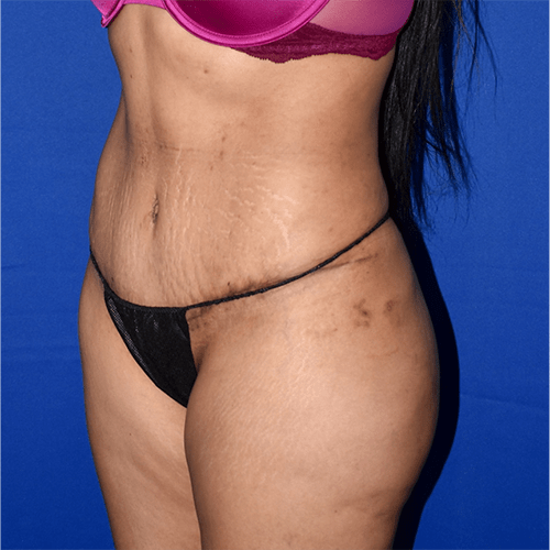 Abdominoplasty