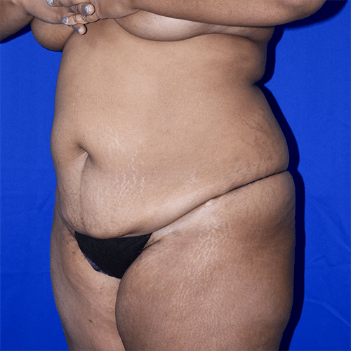 Abdominoplasty