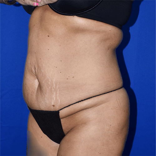 Abdominoplasty